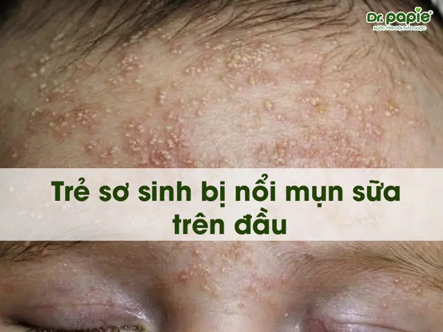 Mụn Sữa Trên Đầu Trẻ Sơ Sinh