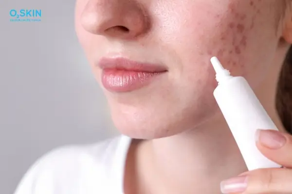 Nặn Mụn Xong Bôi Gì Để Không Bị Thâm