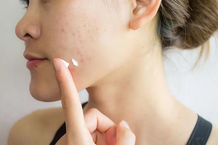 Nên Bôi Thuốc Trị Mụn Khi Nào
