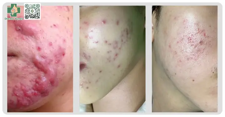 Nên Nặn Mụn Vào Lúc Nào
