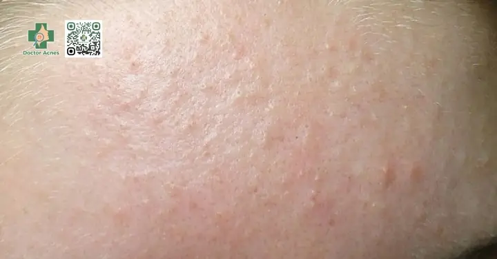 Nên Nặn Mụn Vào Lúc Nào