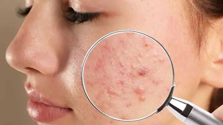 Nên Nặn Mụn Vào Lúc Nào