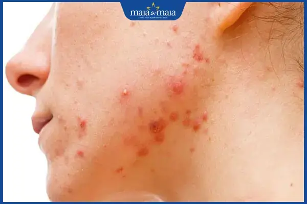 Nên Nặn Mụn Vào Thời Gian Nào Trong Ngày