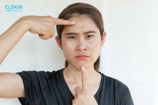 Nên Nặn Mụn Vào Thời Gian Nào Trong Ngày