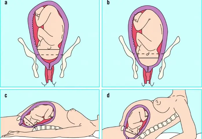 Ngôi Thai Chưa Cố Định Là Sao