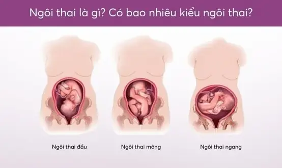 Ngôi Thai Chưa Cố Định Là Sao