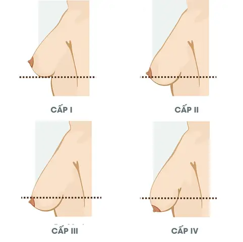 Ngực Phụ Nữ Sau Khi Cho Con Bú