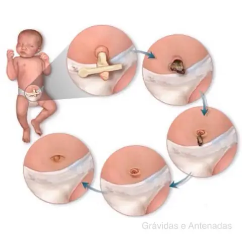 Nhiễm Trùng Rốn Bé Sơ Sinh