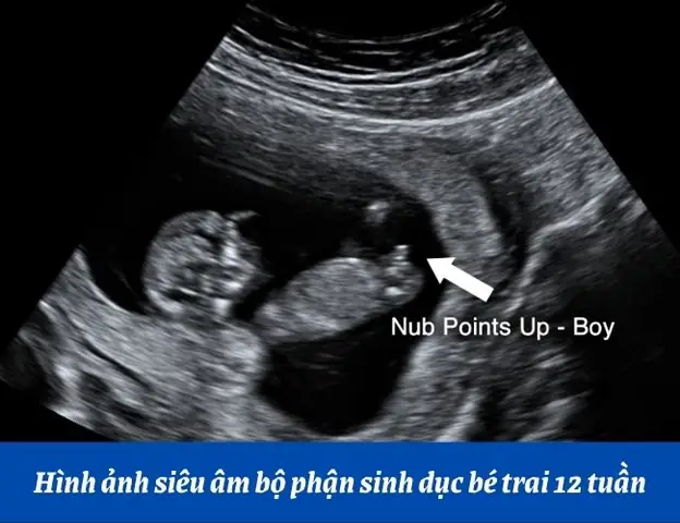 Nhịp Tim Của Thai Nhi Tuần Thứ 11