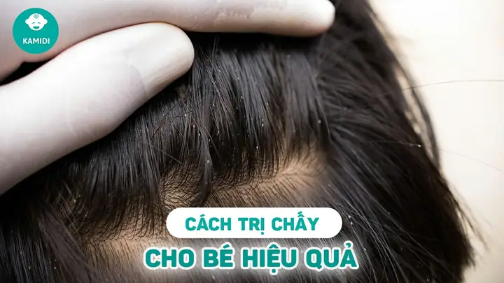 Những Cách Trị Chấy Tại Nhà