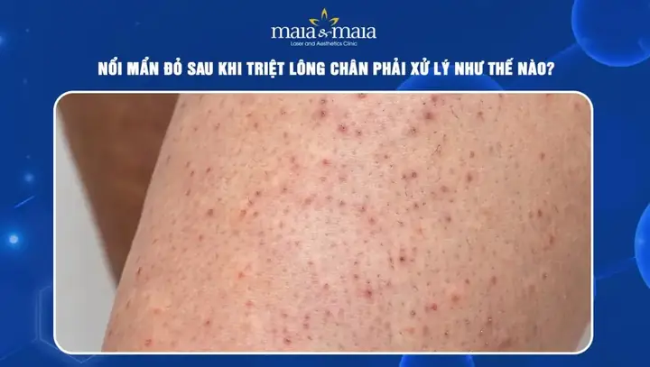 Nổi Mẩn Đỏ Sau Khi Wax Lông