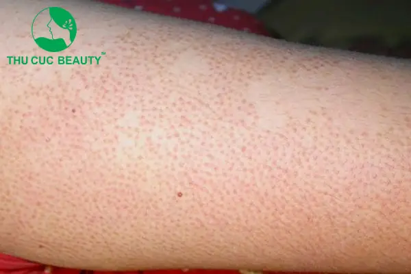 Nổi Mẩn Đỏ Sau Khi Wax Lông