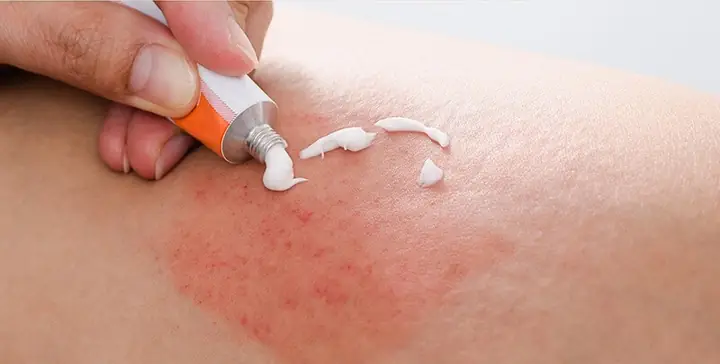 Nổi Mẩn Đỏ Sau Khi Wax Lông