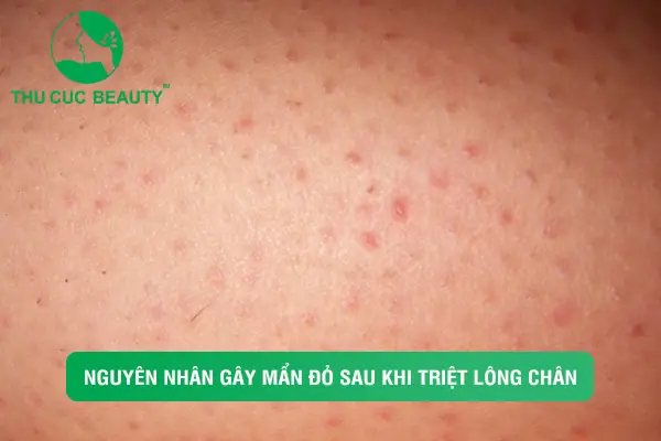 Nổi Mẩn Đỏ Sau Khi Wax Lông