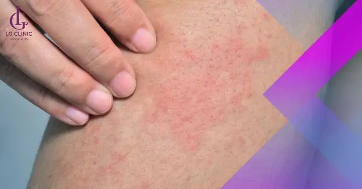 Nổi Mẩn Đỏ Sau Khi Wax Lông