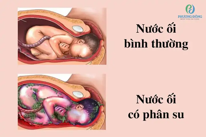 Nước Ối Hơi Nhiều Phải Làm Sao