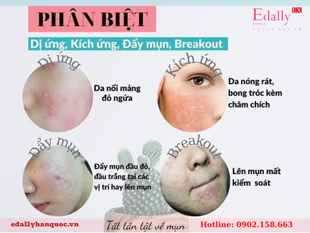 Phân Biệt Giữa Đẩy Mụn Và Break Out Phân Biệt Giữa Đẩy Mụn Và Break Out