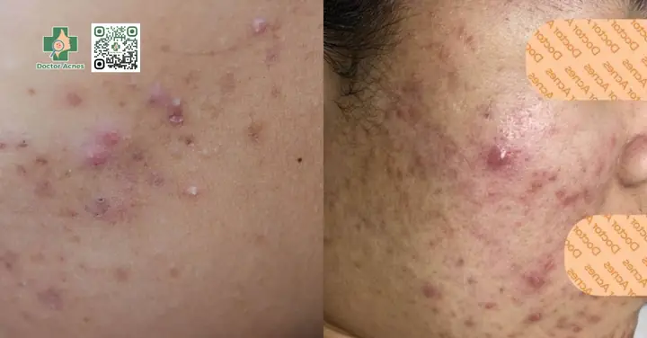 Quá Trình Đẩy Mụn Ẩn Mất Bao Lâu