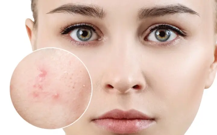 Quá Trình Đẩy Mụn Ẩn Mất Bao Lâu