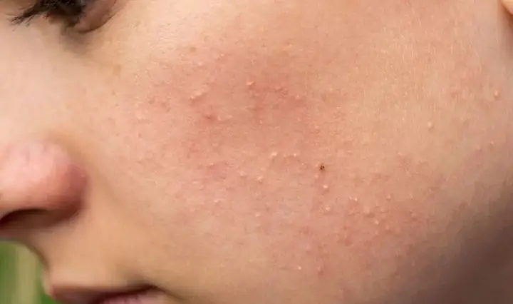 Quá Trình Đẩy Mụn Ẩn Mất Bao Lâu