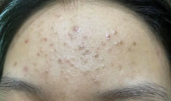 Quá Trình Đẩy Mụn Ẩn Mất Bao Lâu