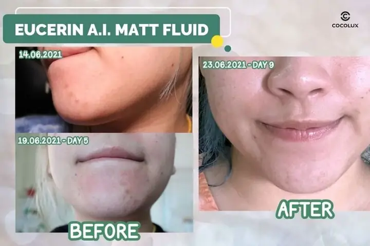 Review Kem Dưỡng Eucerin Pro Acne Solution
