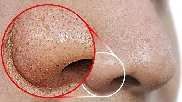 Review Sản Phẩm Trị Mụn Đầu Đen