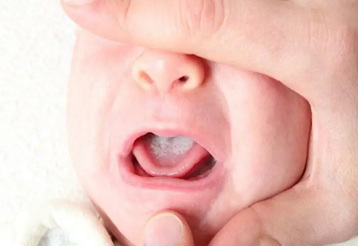 Rơ Lưỡi Cho Trẻ Đúng Cách