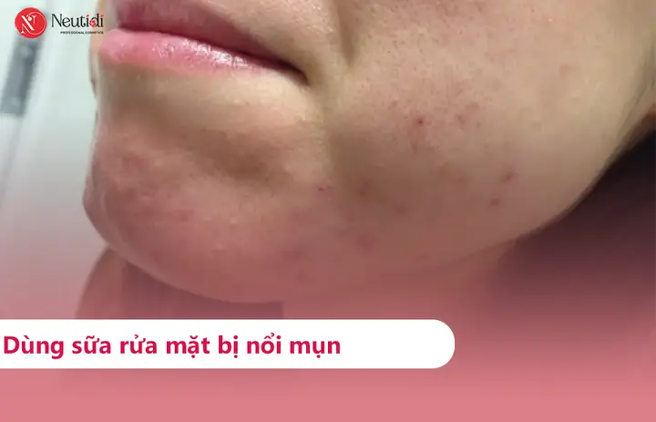 Rửa Mặt Như Thế Nào Để Hết Mụn