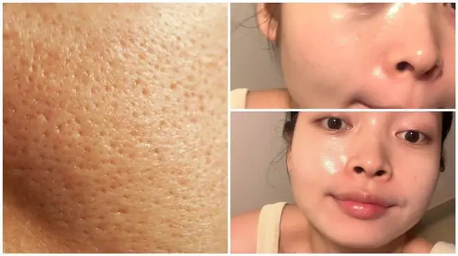 Sản Phẩm Trị Lỗ Chân Lông To