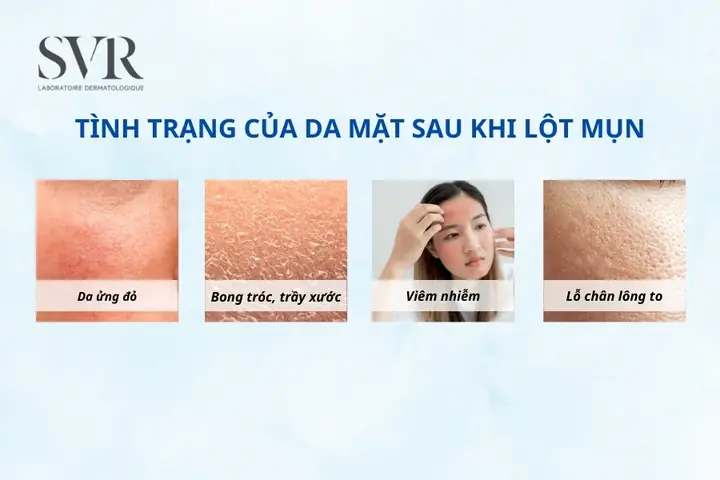 Sau Khi Lột Mụn Xong Nên Làm Gì