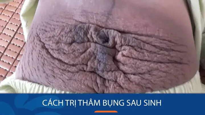 Sau Sinh Bao Lâu Thì Hết Thâm Bụng Sau Sinh Bao Lâu Thì Hết Thâm Bụng