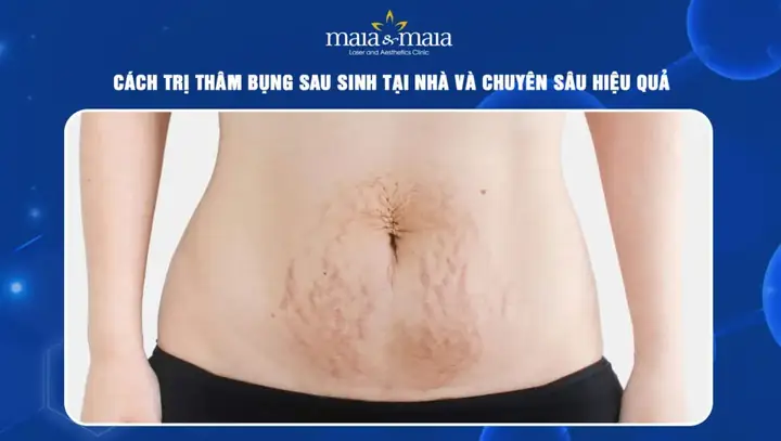 Sau Sinh Bao Lâu Thì Hết Thâm Bụng Sau Sinh Bao Lâu Thì Hết Thâm Bụng