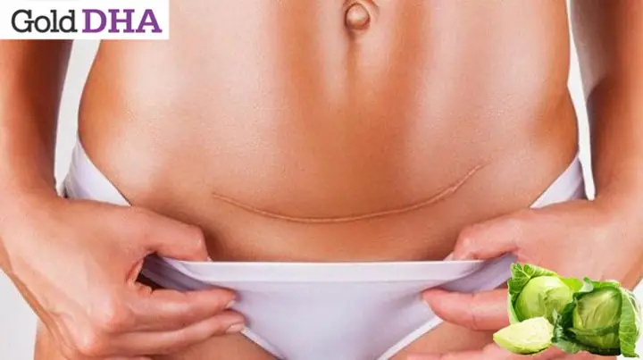 Sau Sinh Có Được Ăn Rau Bắp Cải Không