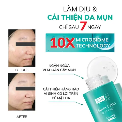 Serum Cho Da Mụn Nhạy Cảm