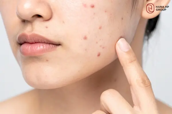 Serum Phục Hồi Da Sau Mụn Review