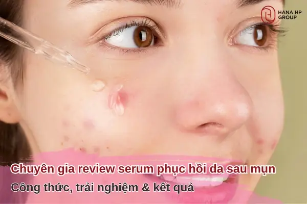 Serum Phục Hồi Da Sau Mụn Review
