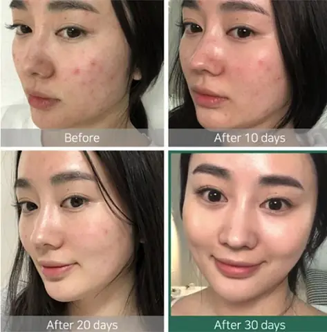 Set Trị Mụn Some By Mi Mini Review