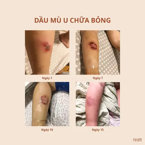 Tác Dụng Phụ Của Dầu Mù U