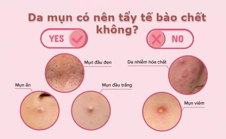 Tẩy Tế Bào Chết Cho Da Mặt Dầu Mụn