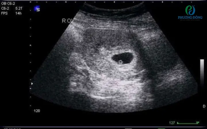 Thai Nhi 5 Tuần Tuổi Nên Ăn Gì