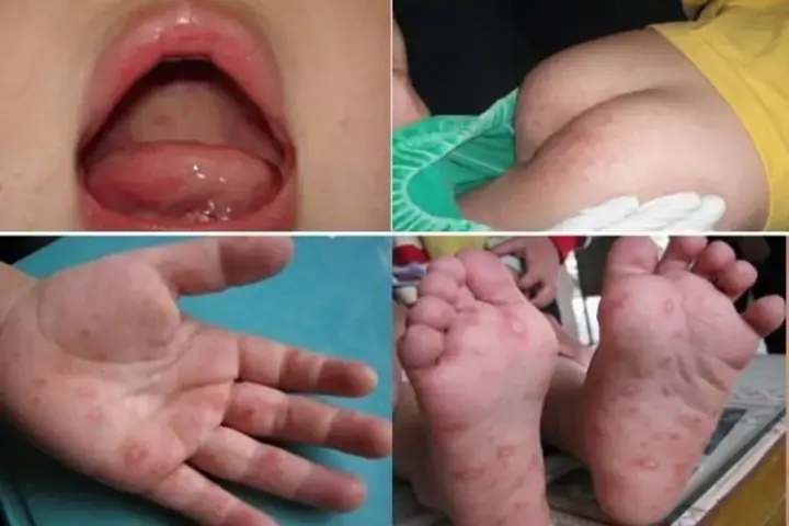 Thân Nhiệt Trẻ Cao Nhưng Không Sốt