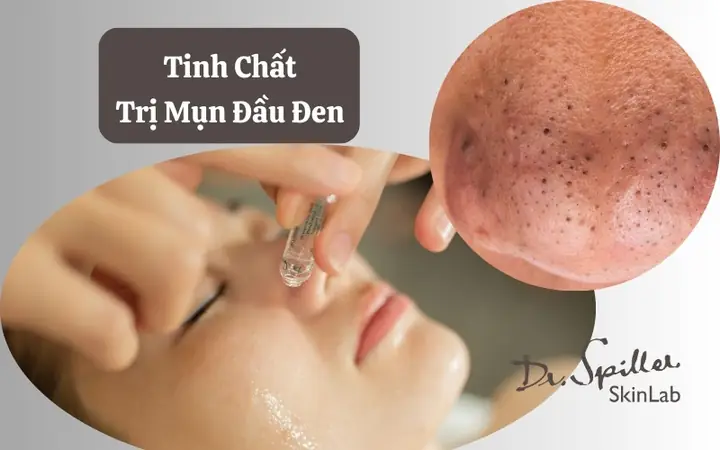 Tinh Chất Trị Mụn Đầu Đen Tinh Chất Trị Mụn Đầu Đen