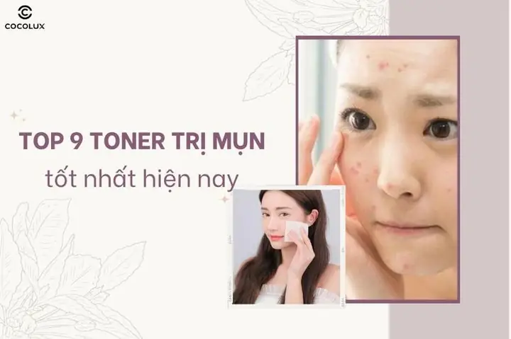 Toner Trị Mụn Tốt Nhất Hiện Nay