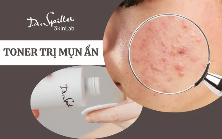 Toner Trị Mụn Tốt Nhất Hiện Nay