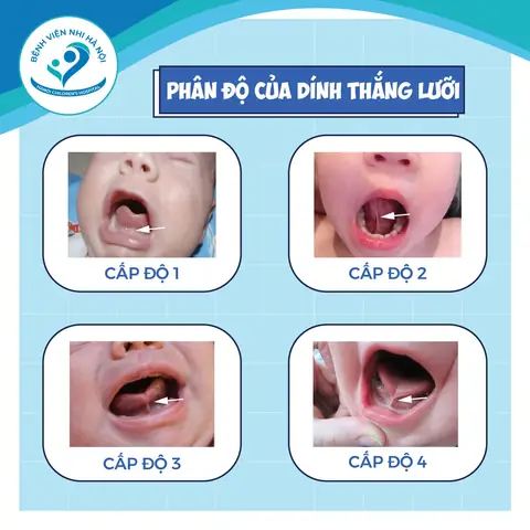 Tre 3 Thang Tuoi Luoi Bu