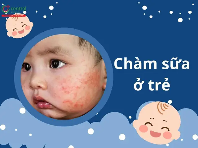 Trẻ Bị Chàm Sữa Bôi Gì