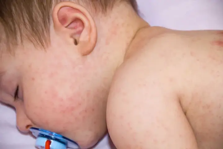 Trẻ Bị Chàm Sữa Bôi Gì