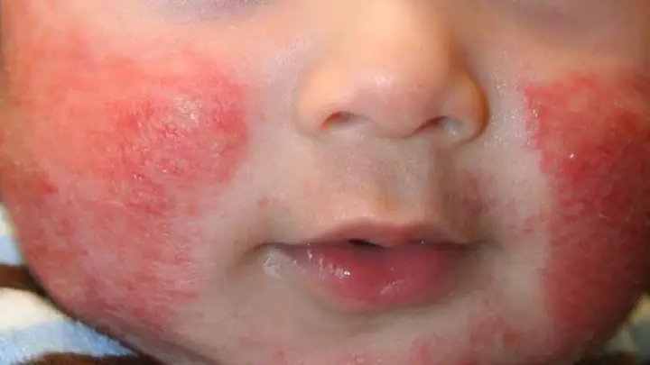 Trẻ Bị Chàm Sữa Bôi Gì