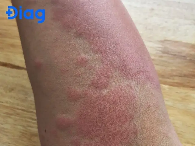 Trẻ Bị Dị Ứng Bôi Thuốc Gì